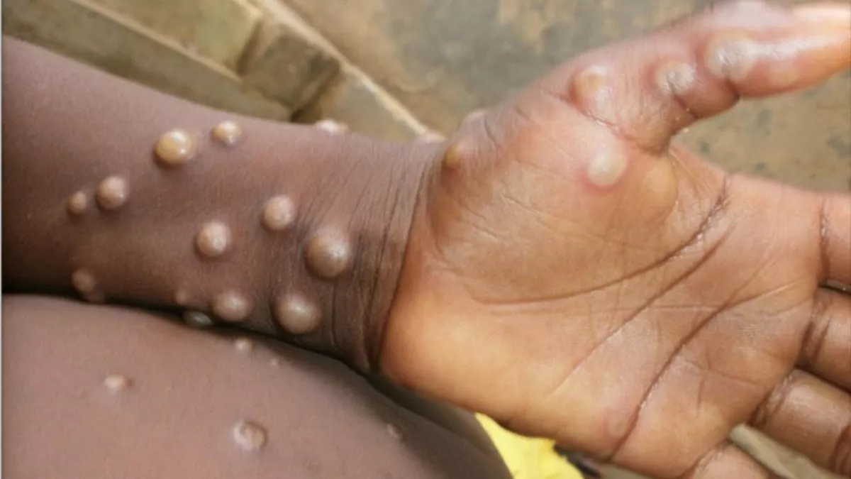 Épidémie de variole du singe : notification du premier cas confirmé en Guinée.