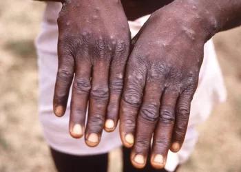 Mpox : en Guinée, l’ANSS renforce la vigilance à la frontière avec la Sierra Leone.